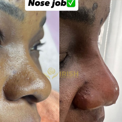 Liquid Rhinoplasty​