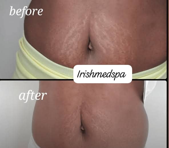 Strech mark and scar camouflage