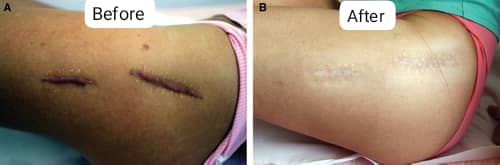 Scar Resurfacing Treatment